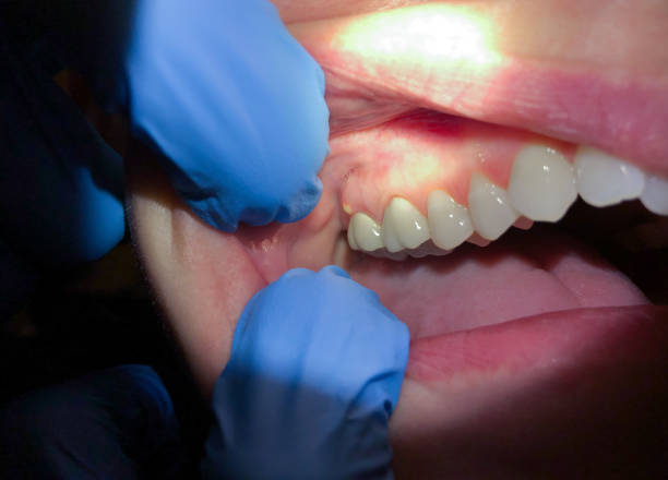 Best Emergency Dental Care for Abscessed Tooth in Pineville, KY